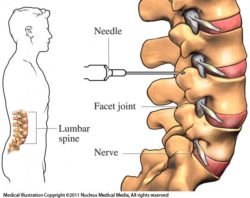 Sacroiliac joint steroid injection procedure