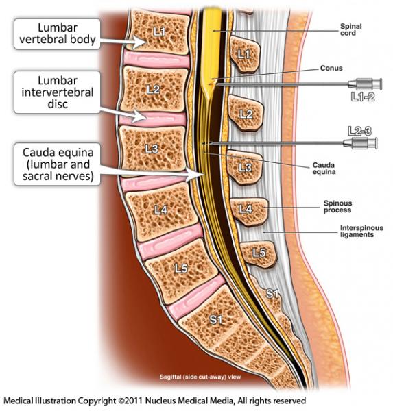 How long does a lumbar myelogram procedure typically last?