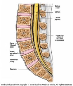 Cervical epidural steroid injection under fluoroscopy