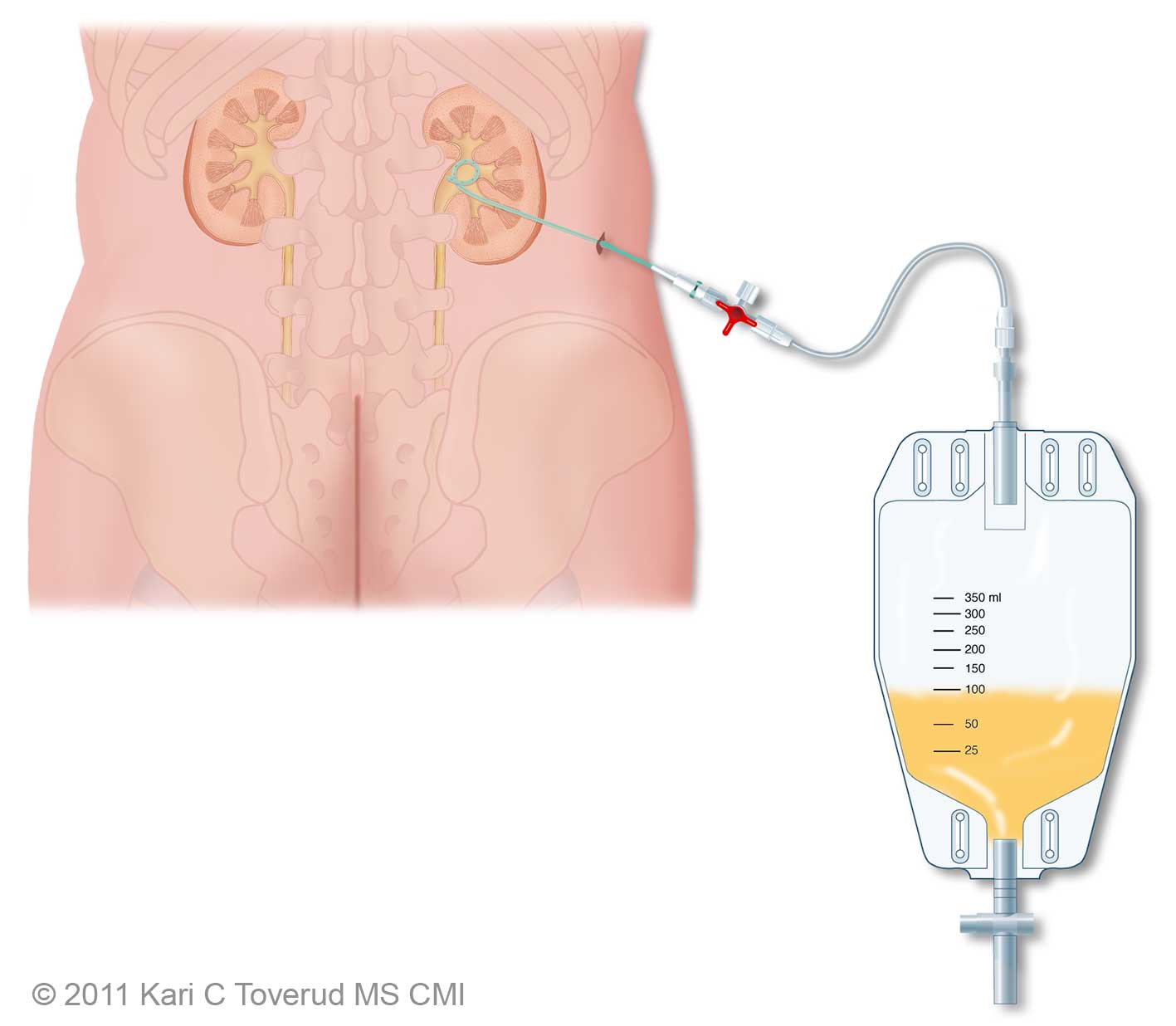 nephrostomy