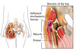 Iliopsoas tendon steroid injection